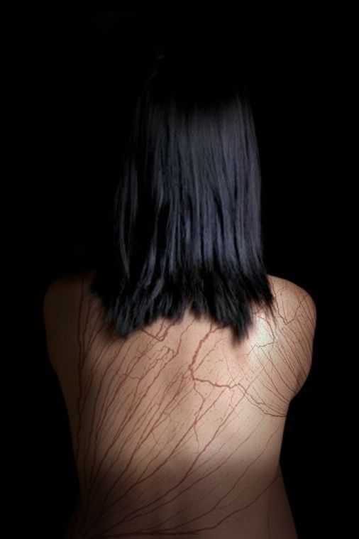 被闪电击中留下的“刺青图案” 永久性伤疤当纪念品