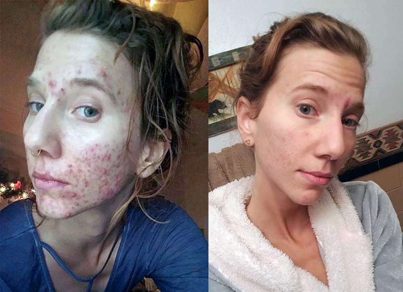 画家喝尿治痘痘皮肤变好 每天还用3杯尿洗脸瘦了27.2斤