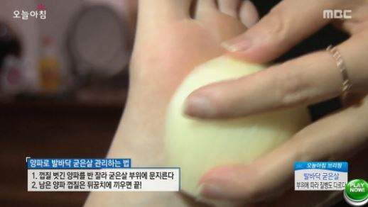 硬脚皮怎么去掉 韩国节目推荐用洋葱去脚皮超可爱